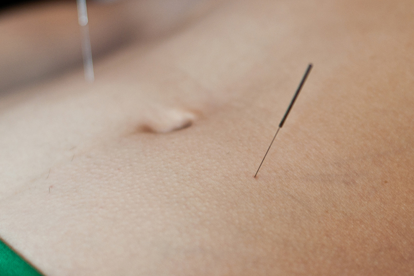 acupuncture pain relief minneapolis